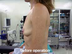 plastic-surgery-breast-augmentation 